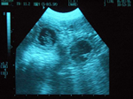 mini_ultrazvuk